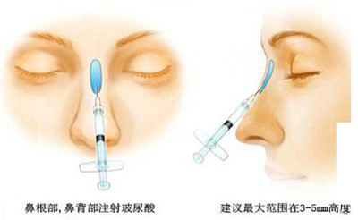 关于隆鼻手术的一些常识介绍