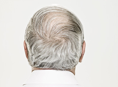 患者如何治疗遗传性白发