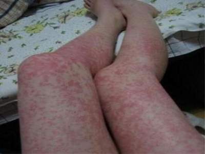 过敏性湿疹性皮炎有什么症状