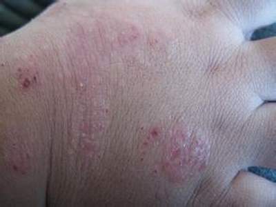 泛发性皮炎湿疹有什么表现