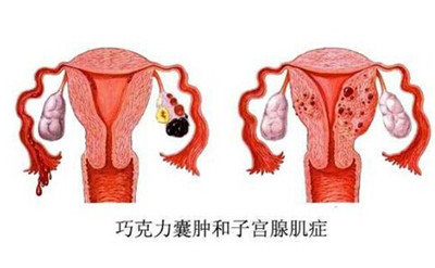 出现卵巢囊肿是否会对生育造成影响__寻医问