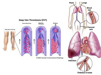 术后康复之静脉血栓的形成