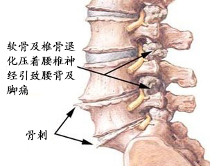 腰椎退变性疾病防治要趁早