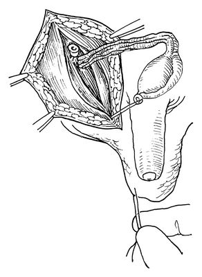睾丸固定术的图解过程