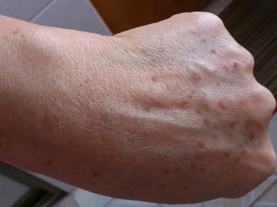 老人频道 健康养生  老年斑是一种老人常会出现的皮肤问题,无论是轻度