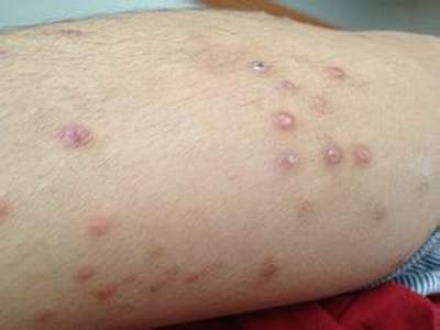 糜烂,流出渗液,并且外围可有明显的红斑,丘疹,小水泡,脓疱等急性湿疹