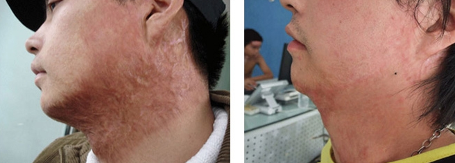 北京激光祛疤会伤害皮肤吗
