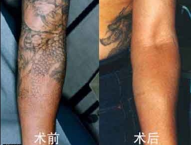 上海手术法去纹身有副作用吗