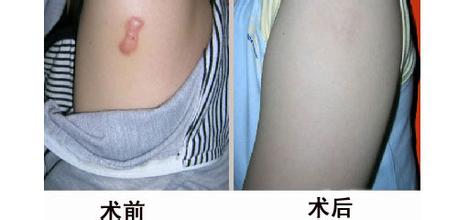 上海激光祛疤有副作用吗?