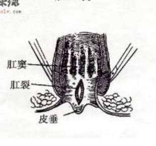 有问题必答知识网 肛裂 肛裂的常识 正文  1,梭形溃疡:肛管皮肤裂伤