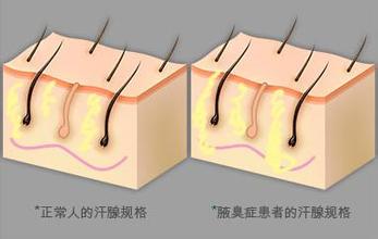 无疑是令患者最为烦恼的,常见的是由于毛囊肥大,遗传,大汗腺,不良习惯