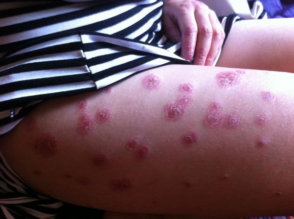 丘疹性荨麻疹皮肤病在北京传染吗