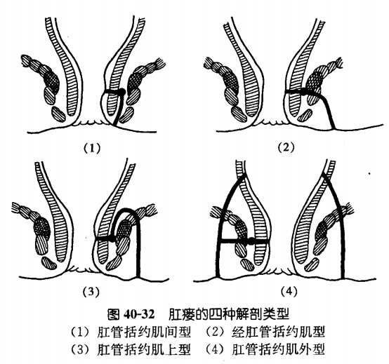 肛瘘久拖不治可癌变