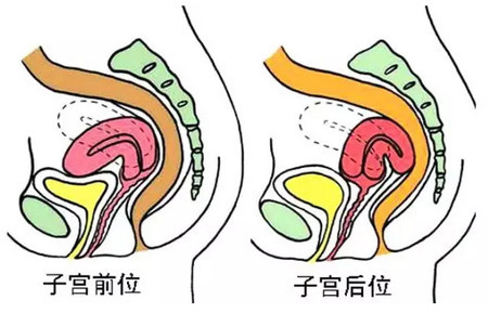 带你了解子宫前后位对孕育的影响