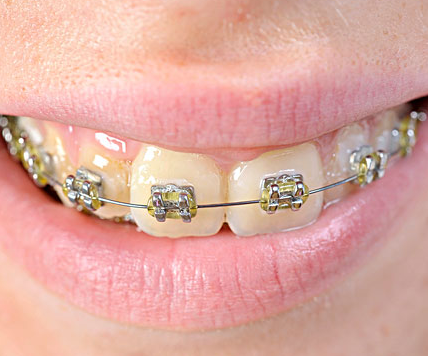 牙齿整形手术的进行步骤1.制定矫正方案.