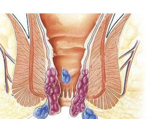 湖南痔疮便血的危害有哪些