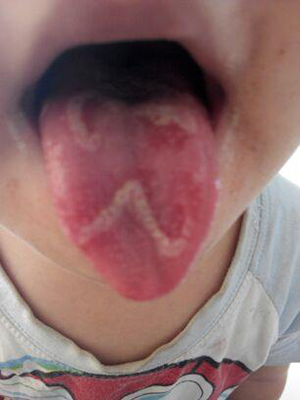 一般无症状,在吃刺激性的食物时舌头感到有点麻.
