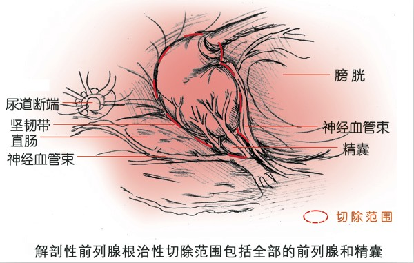 前列腺癌手术=阳痿?不,我们不怕!