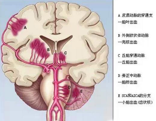 我妈因为脑出血造成半边瘫痪然后叫了我们乡村