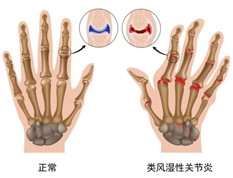 五毛钱的偏方治好风湿骨痛患者强烈反响要让更