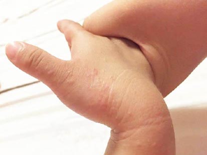导致儿童皮肤过敏的原因是什么