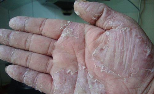 由于用手抓痒处,常传染至手而发生手癣,真菌在指(趾)甲上生长,则成