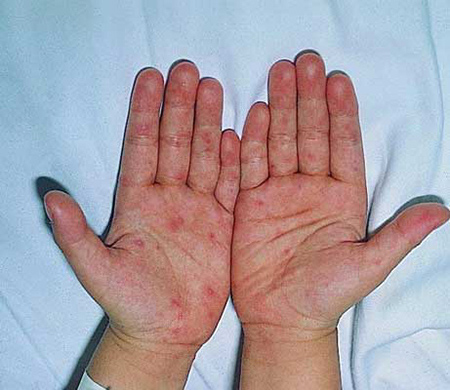 手指上会有二期梅毒的病症吗