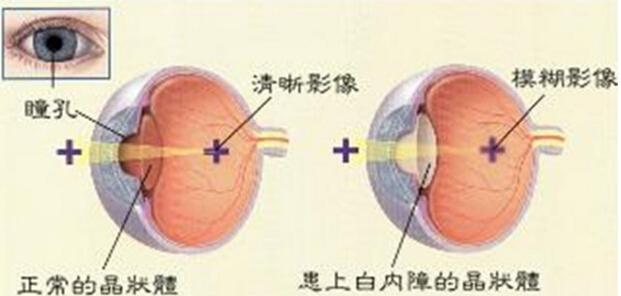 白内障会自己痊愈吗