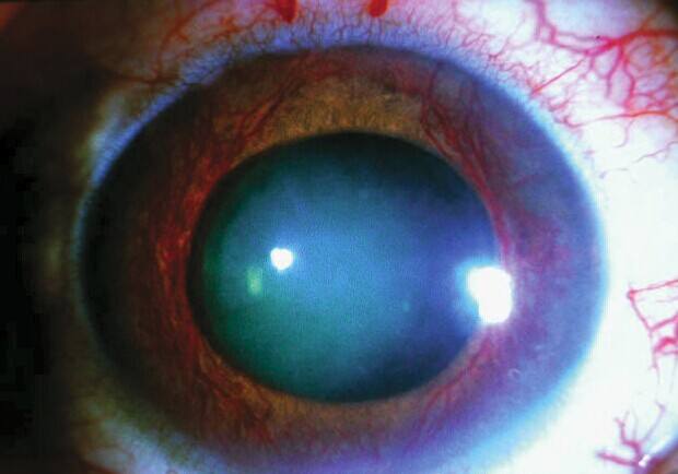 青光眼都有哪些早期症状