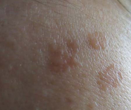 扁平疣生一般都是在脸上,手背上出现扁平的丘疹,颜色与皮肤颜色相近