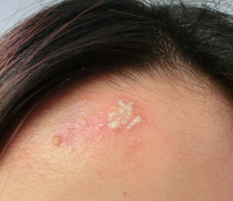 毒疮,指皮肤上带有毒性的疮疤肿烂化脓,又称溃疡病.