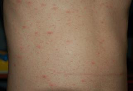疥疮发病过程中有体液和细胞免疫参与,瘙痒症状状与疥螨在皮损中活动