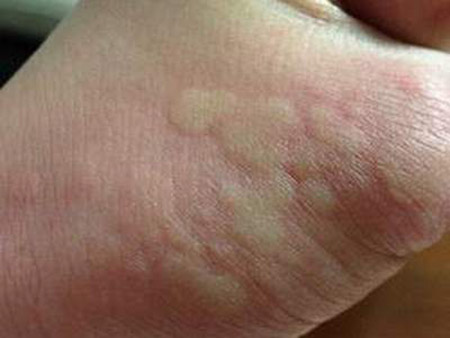引起四肢荨麻疹的原因有哪些