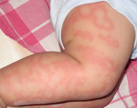 导致小孩皮肤过敏的原因是什么