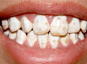 是牙齿结构发育异常的一种疾病