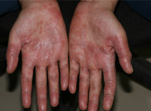 感染引起的疾病称为真菌病,发病率最高的念珠菌病和皮肤癣菌病由人体