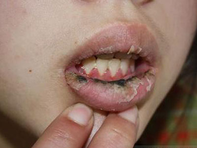 而将病因不明,不能进行分类的慢性以脱屑为主的唇炎列入剥脱性唇炎
