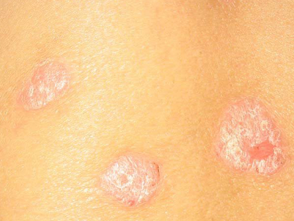 初发皮疹可为猩红热样或麻疹样﹐皮疹迅速扩展﹑融合并延及全身﹐形成