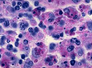 布氏杆菌红斑