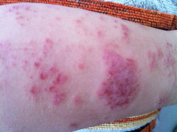湿疹(eczema)是一种常见的变态反应性,非传染性,过敏性表皮炎症,由多