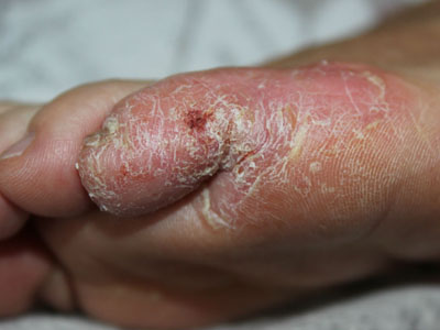 包括掌跖脓疱性银屑病(pustularpsoriasisofthepalmaandsoles)和脓疱