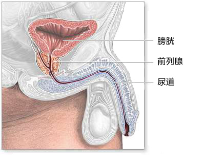 前列腺癌