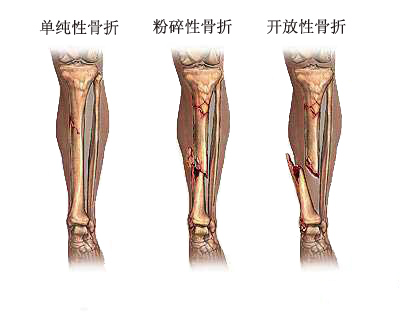 骨折图高清