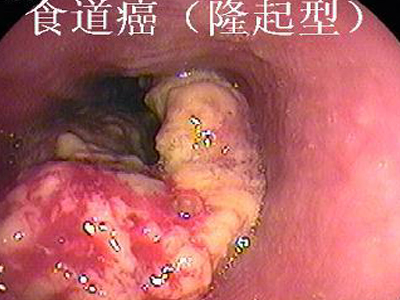 食管癌的发生与亚硝胺慢性刺激,炎症与创伤,遗传因素以及饮水,粮食和