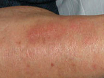 丝虫病(filariasis)是由丝虫成虫寄生于人体淋巴系统而引起的寄生虫病