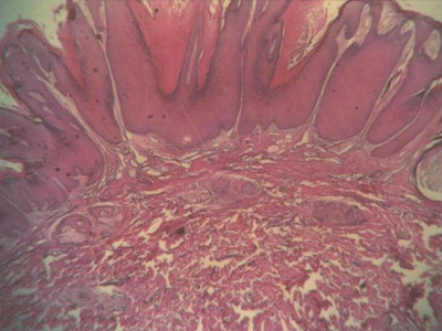 寻常疣是由人类乳头瘤病毒所引起的表皮肿瘤,中医称"千日疮,俗称"