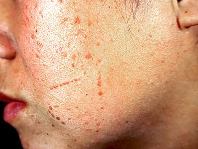 皮疹为米粒至黄豆大的扁平疣状丘疹,圆形或多角形,质地坚硬,淡灰,暗红