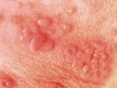 生殖器疱疹(genitalherpes)是由单纯疱疹病毒(herpessimplexvirus,hsv