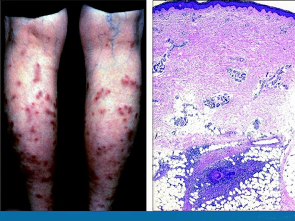 性血管炎(nodularvasculitis)是以淋巴细胞浸润为主的皮肤小血管炎