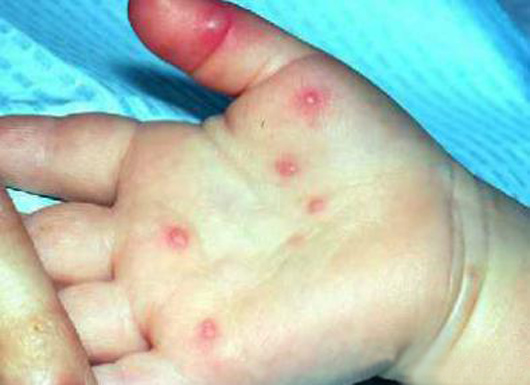 手疱疹,疱疹周围可有炎性红晕,疱内液体较少.